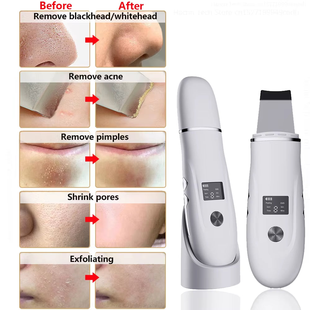 Ultrasonic Skin Scrubber Blackhead Remover Ultrasonic Facial Peeling Scrubber Acne Pore Removal Shovel Deep Cleaning EMS Lifting
